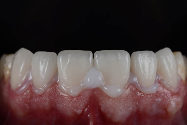 Cementation,Or,Bonding,Procedure,Of,Ceramic,Veneers.,Close,Up,Intra